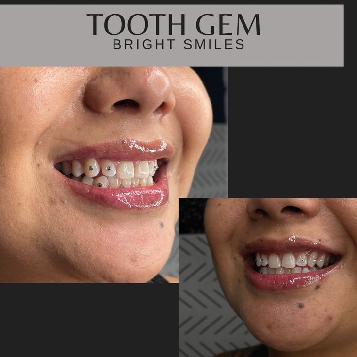 کاشت نگین دندان توسط دکتر دیباجی پور